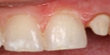 Impacted Canines