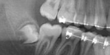 Impacted Wisdom Tooth